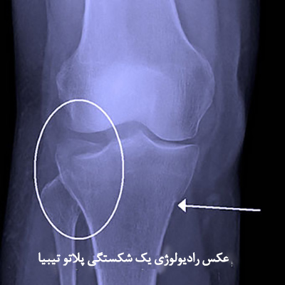 knee-pain-s3-causes-tibial-plateau-fracture