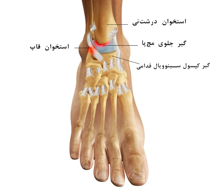 مچ پا